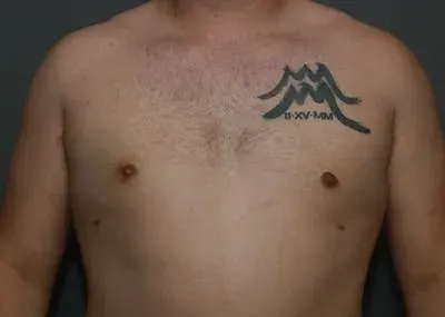 Gynecomastia #13 after