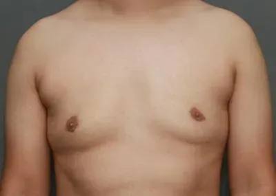 Gynecomastia #14 after