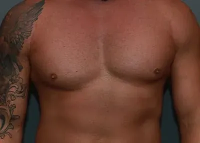 Gynecomastia #15 before