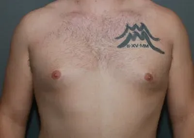 Gynecomastia #13 before