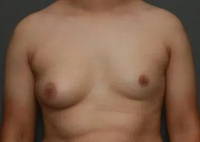 Gynecomastia #14 before