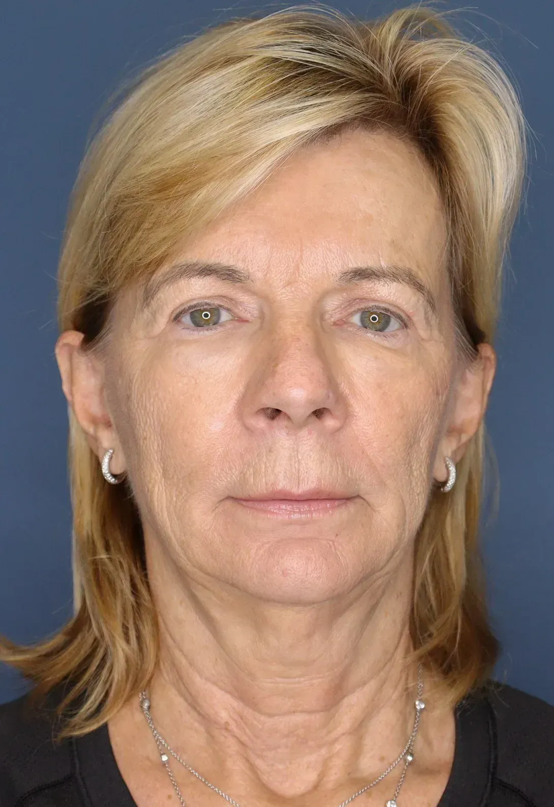 Facelift #14 before