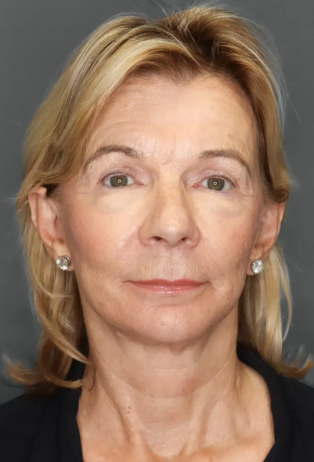 Facelift #14 after