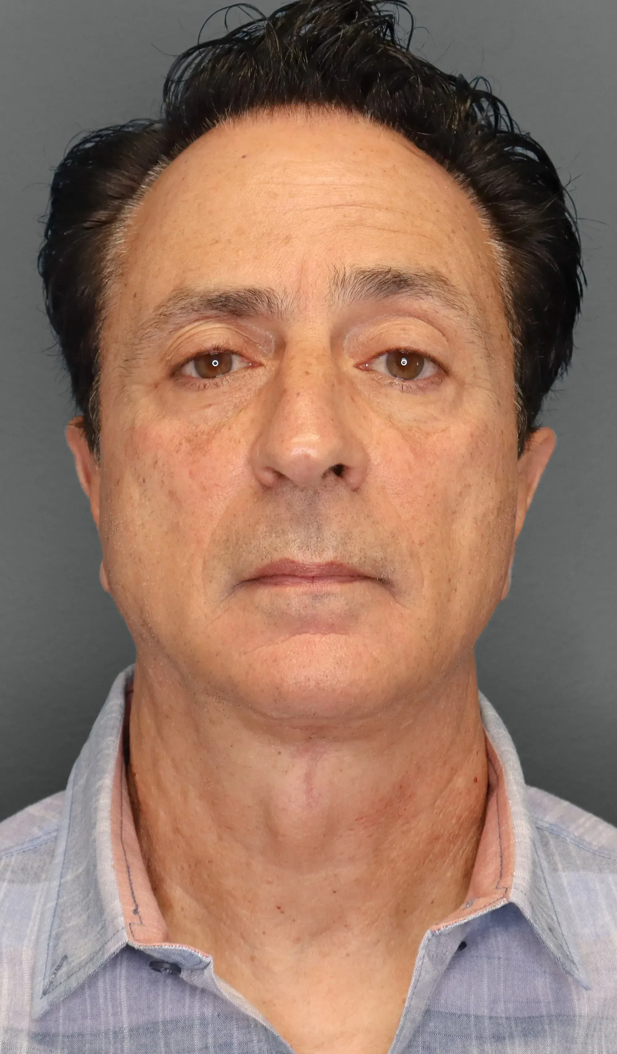 Facelift #13 after