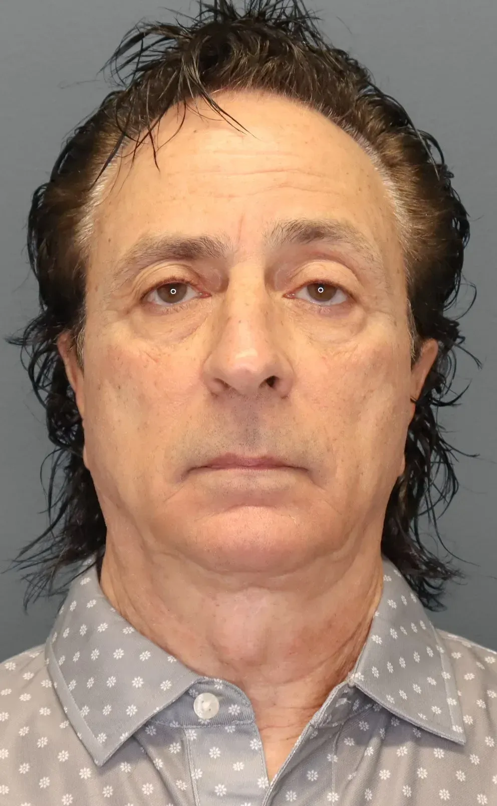 Facelift #13 before
