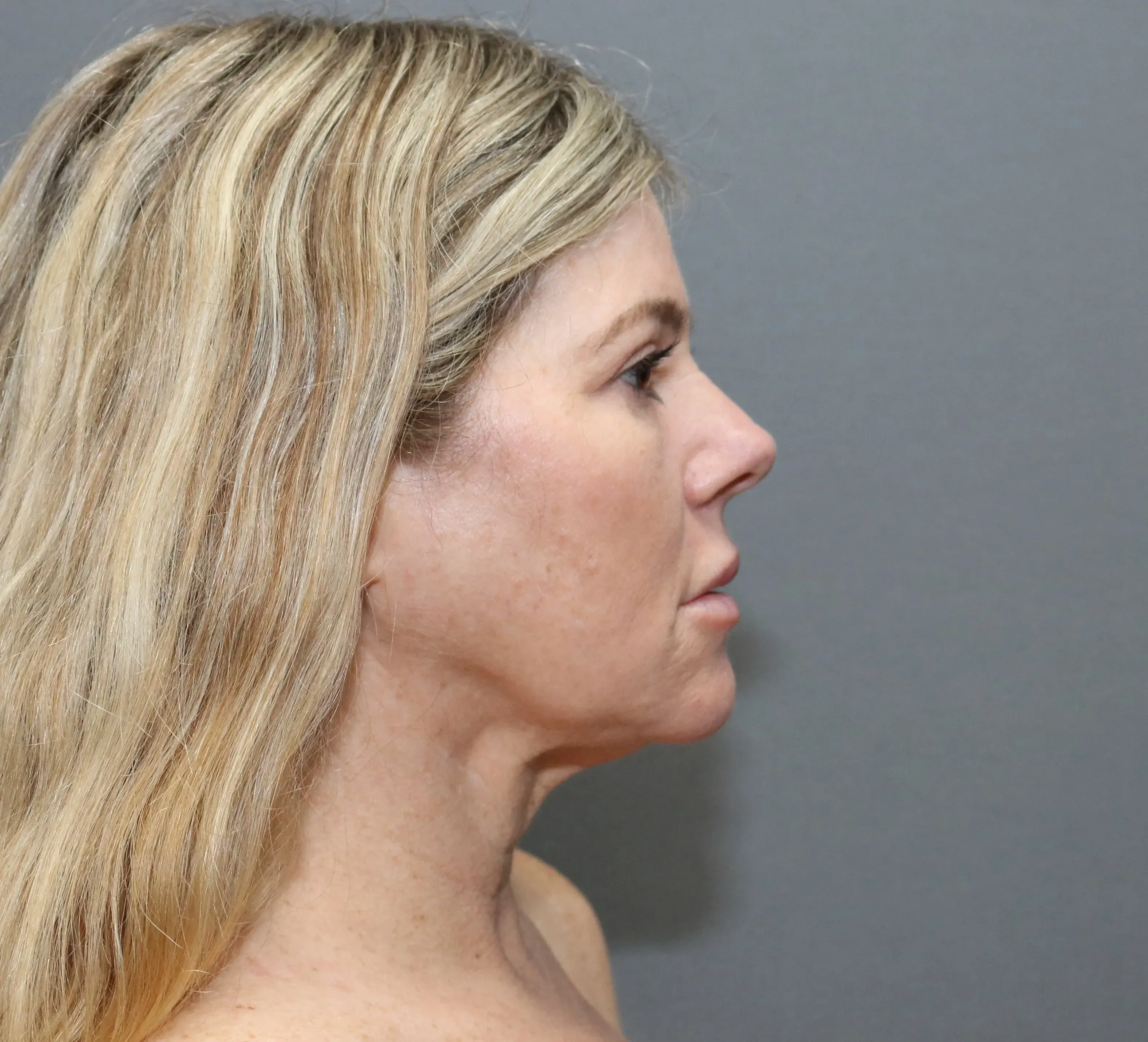 Facelift #12 before