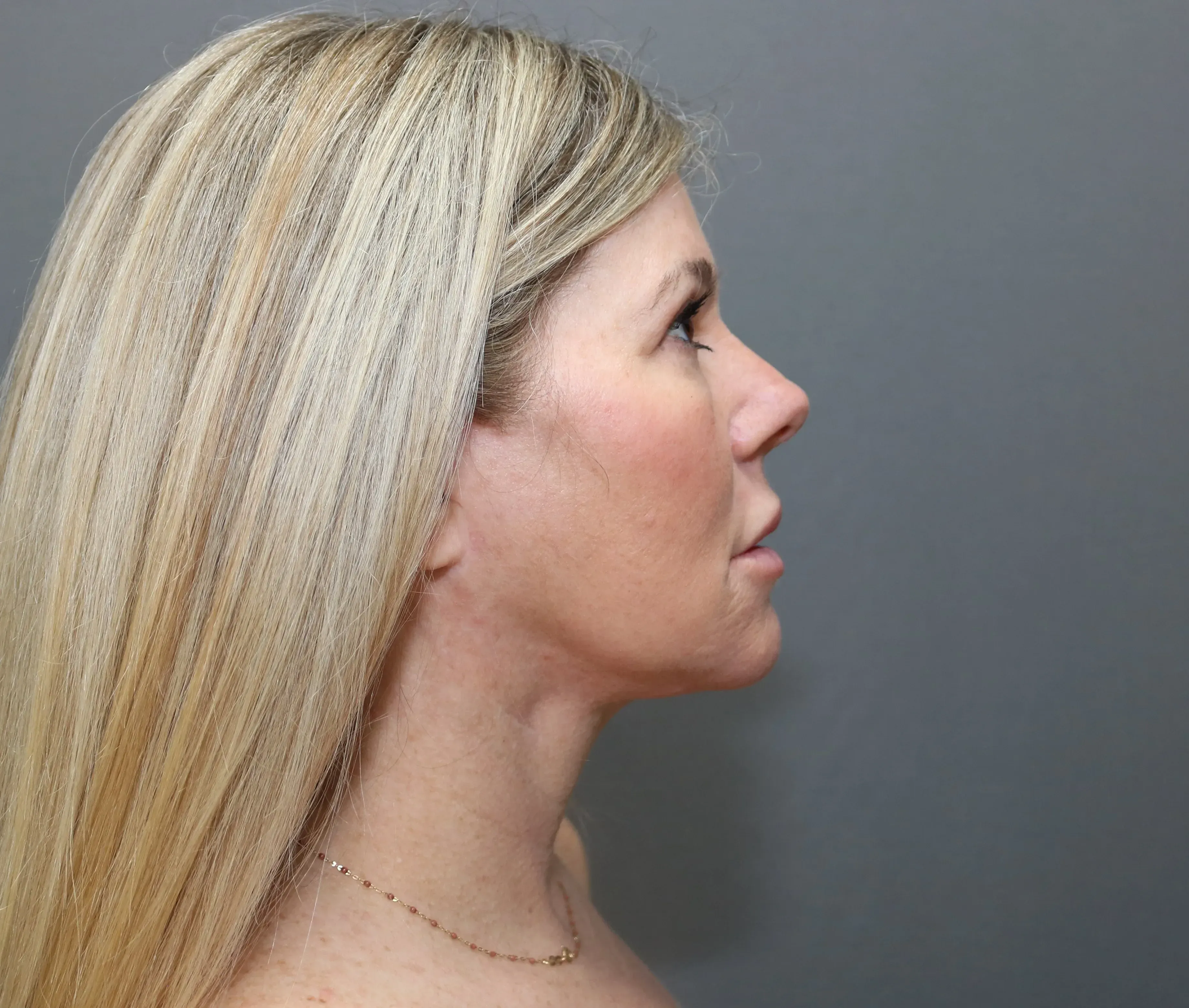 Facelift #12 after