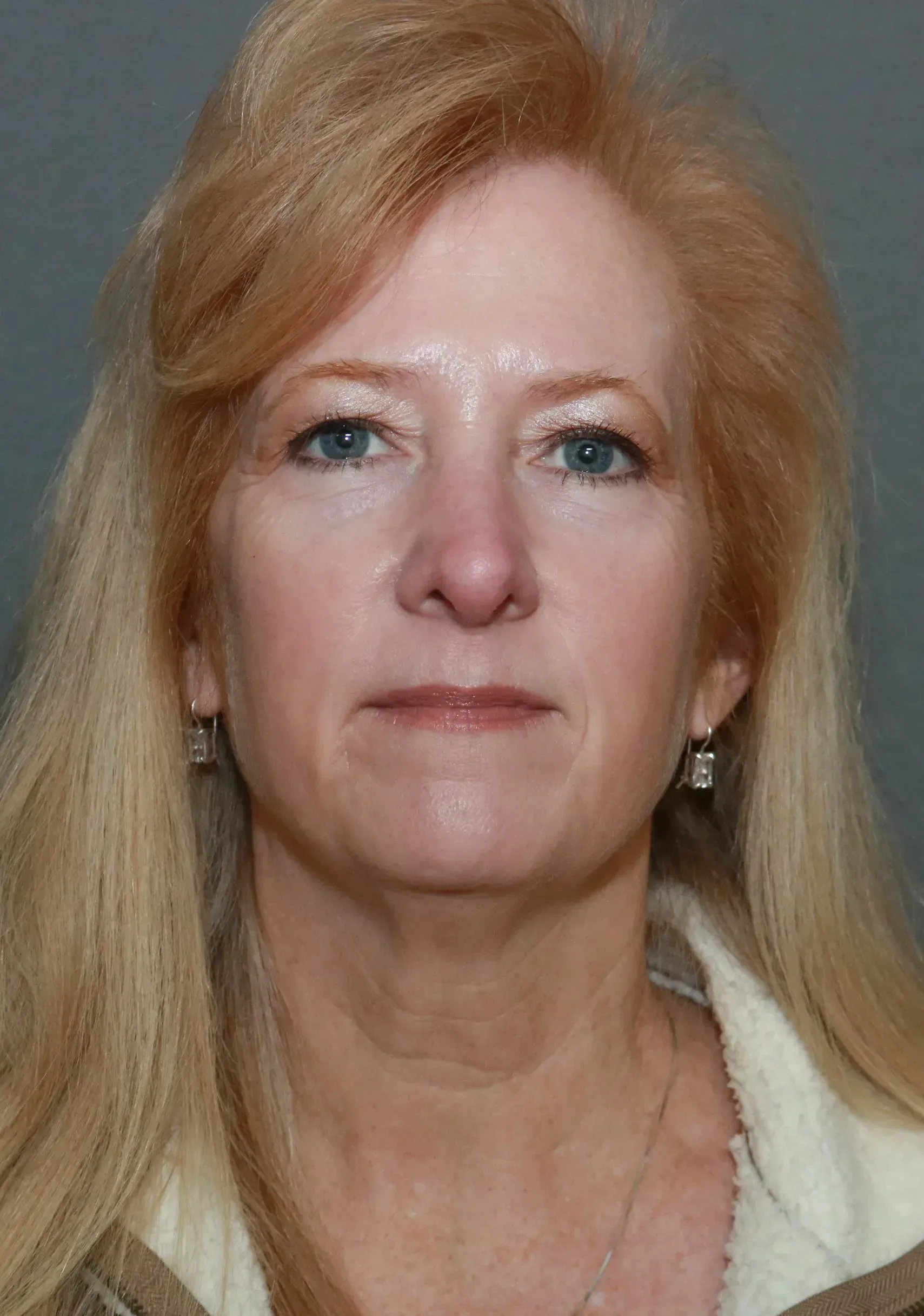 Facelift #11 before