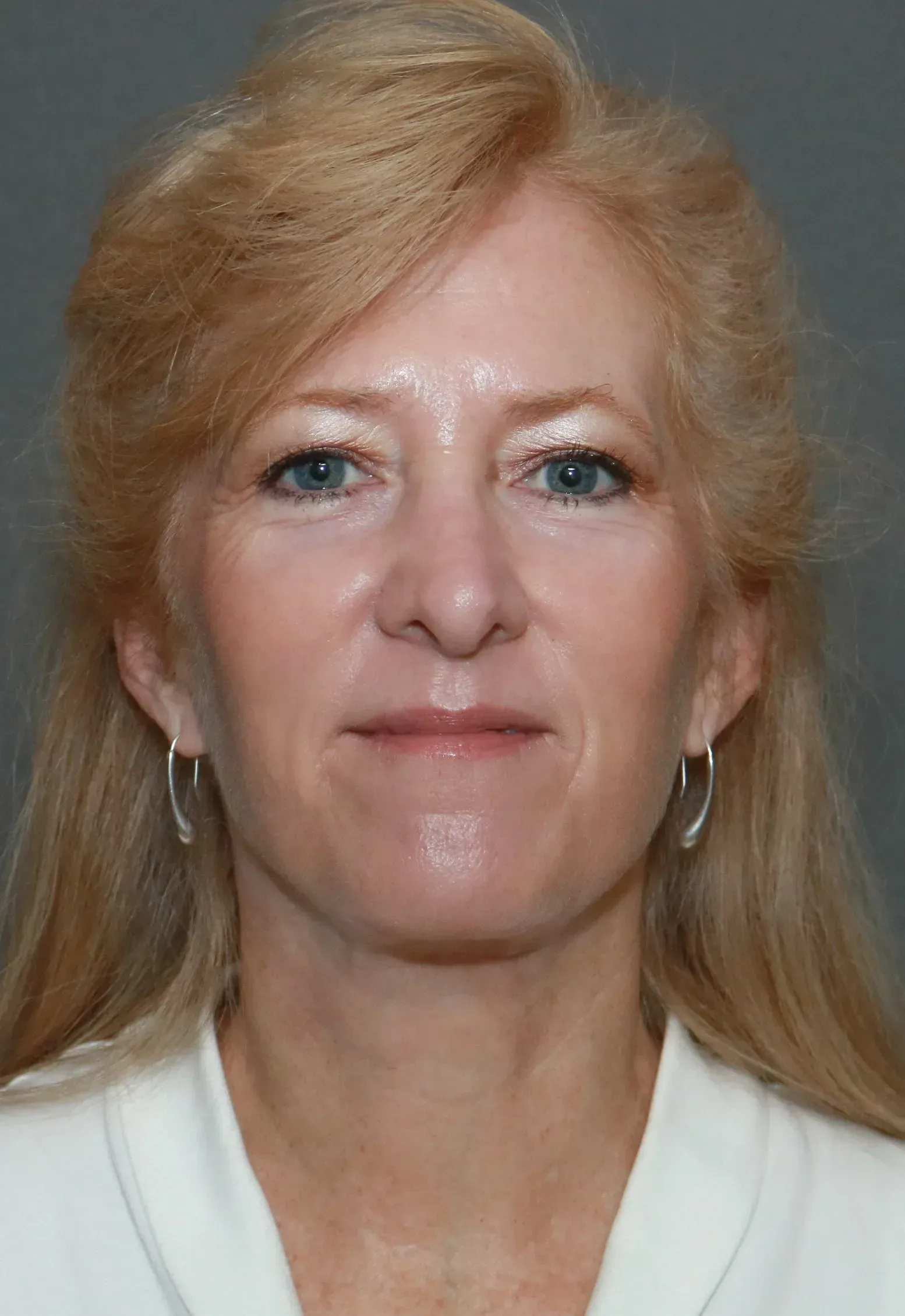 Facelift #11 after