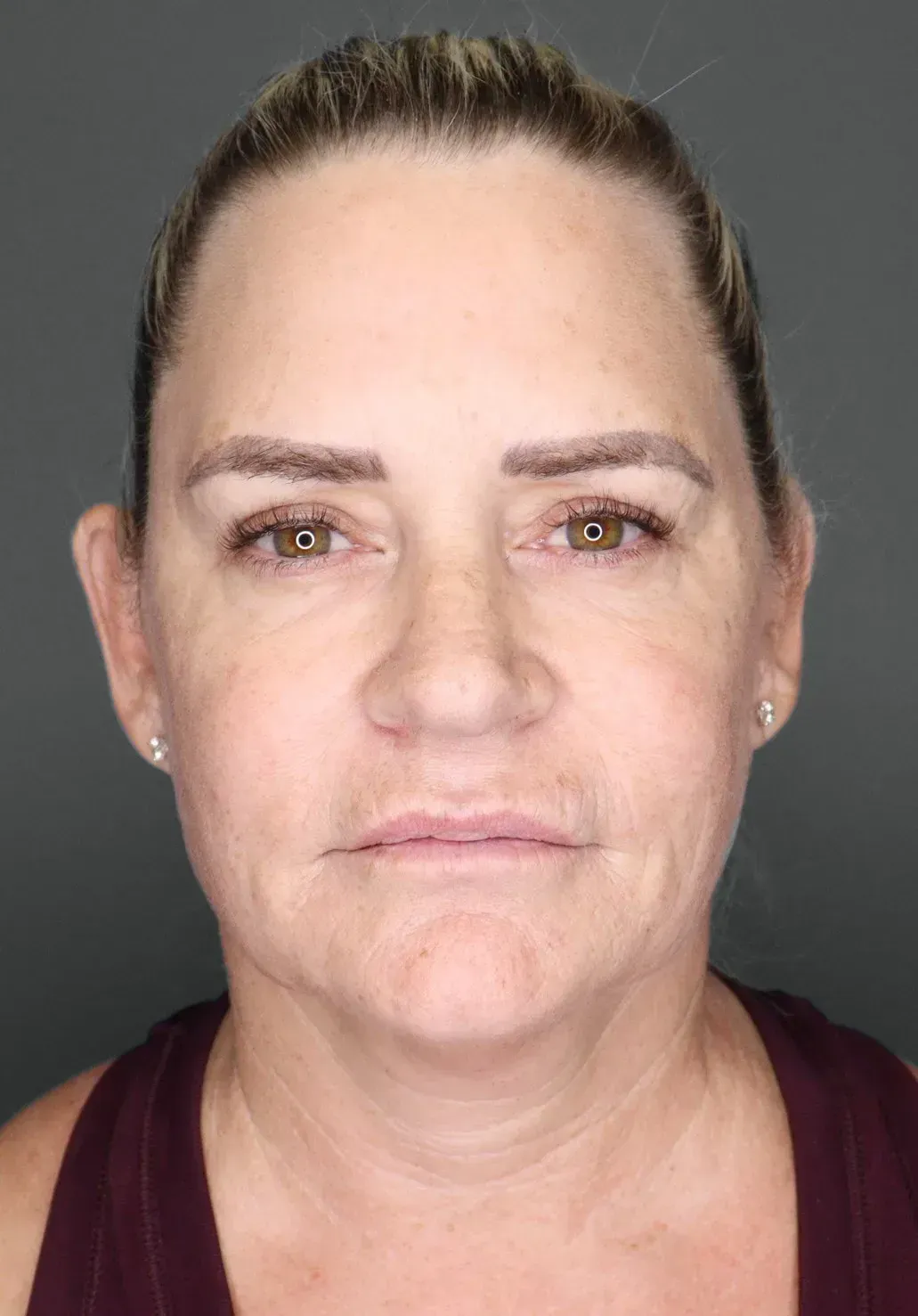 Facelift #10 before