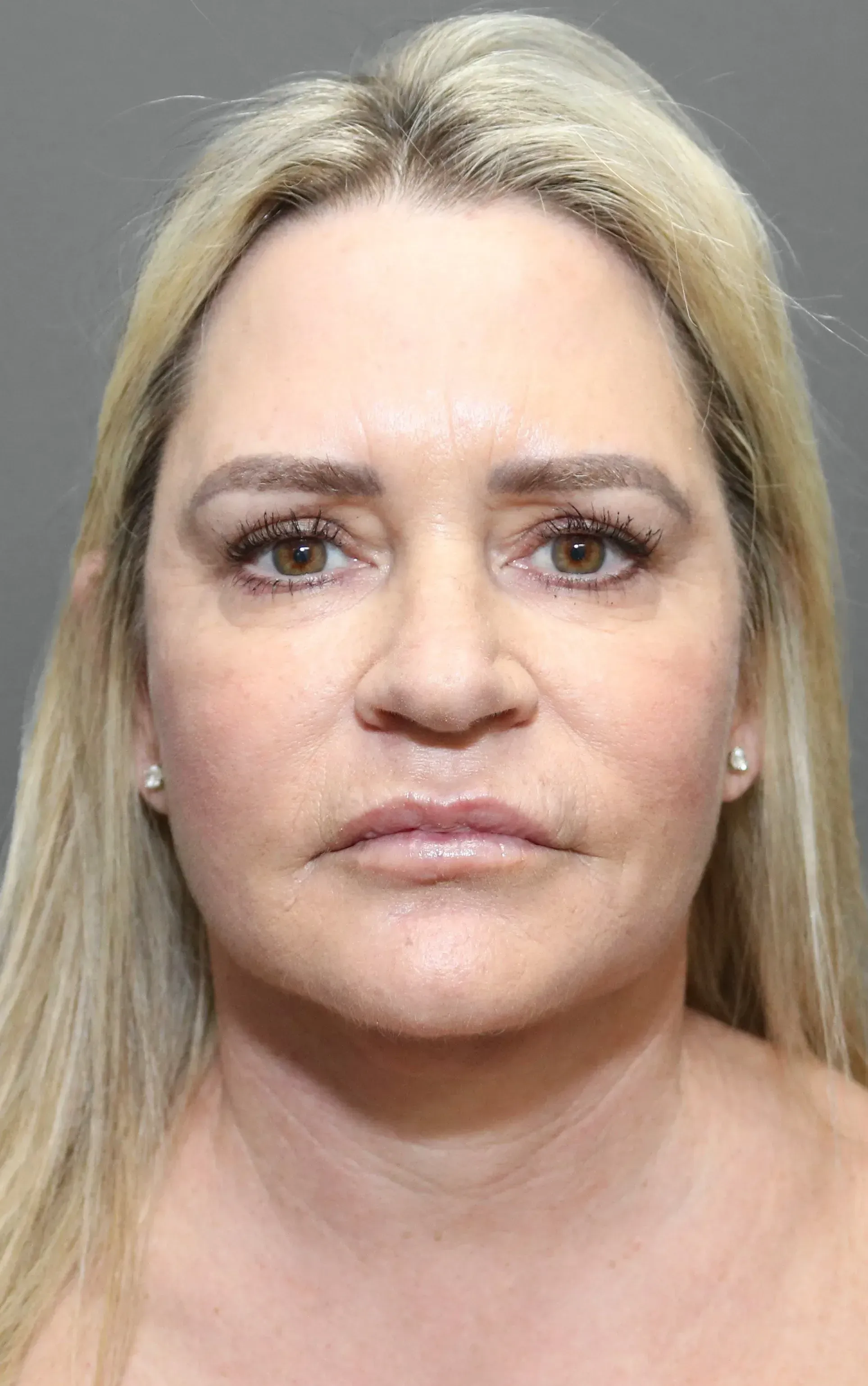 Facelift #10 after