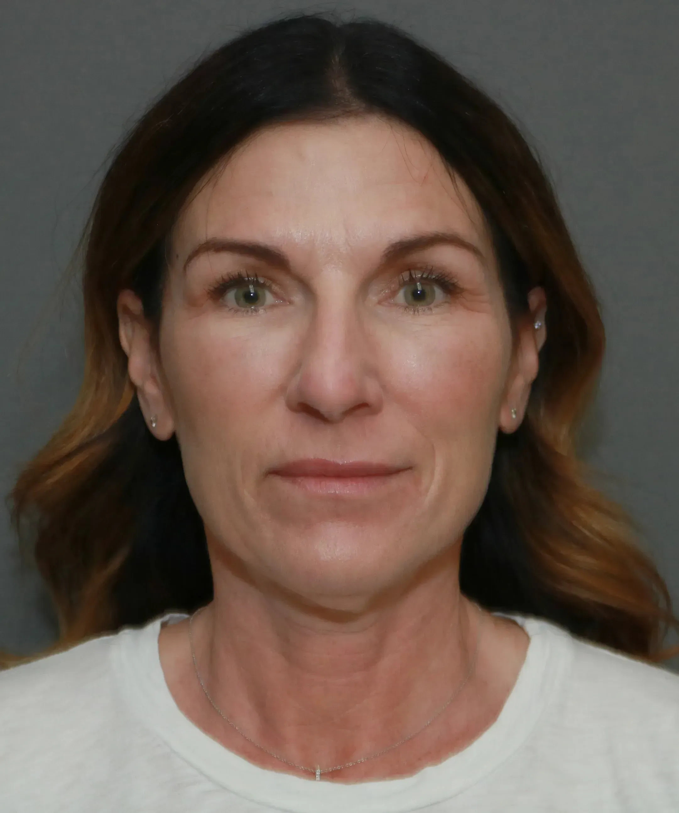 Facelift #9 before