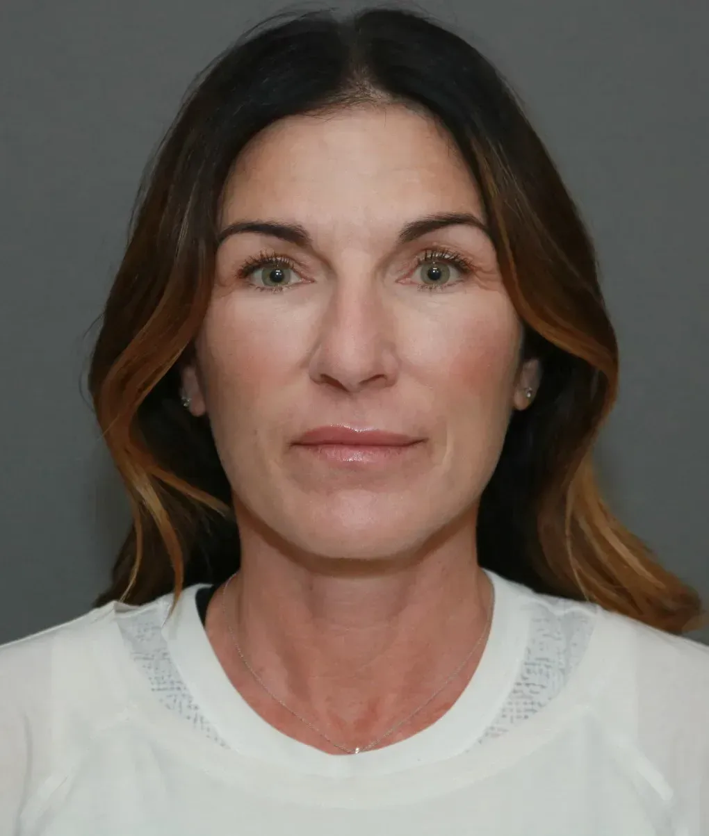 Facelift #9 after