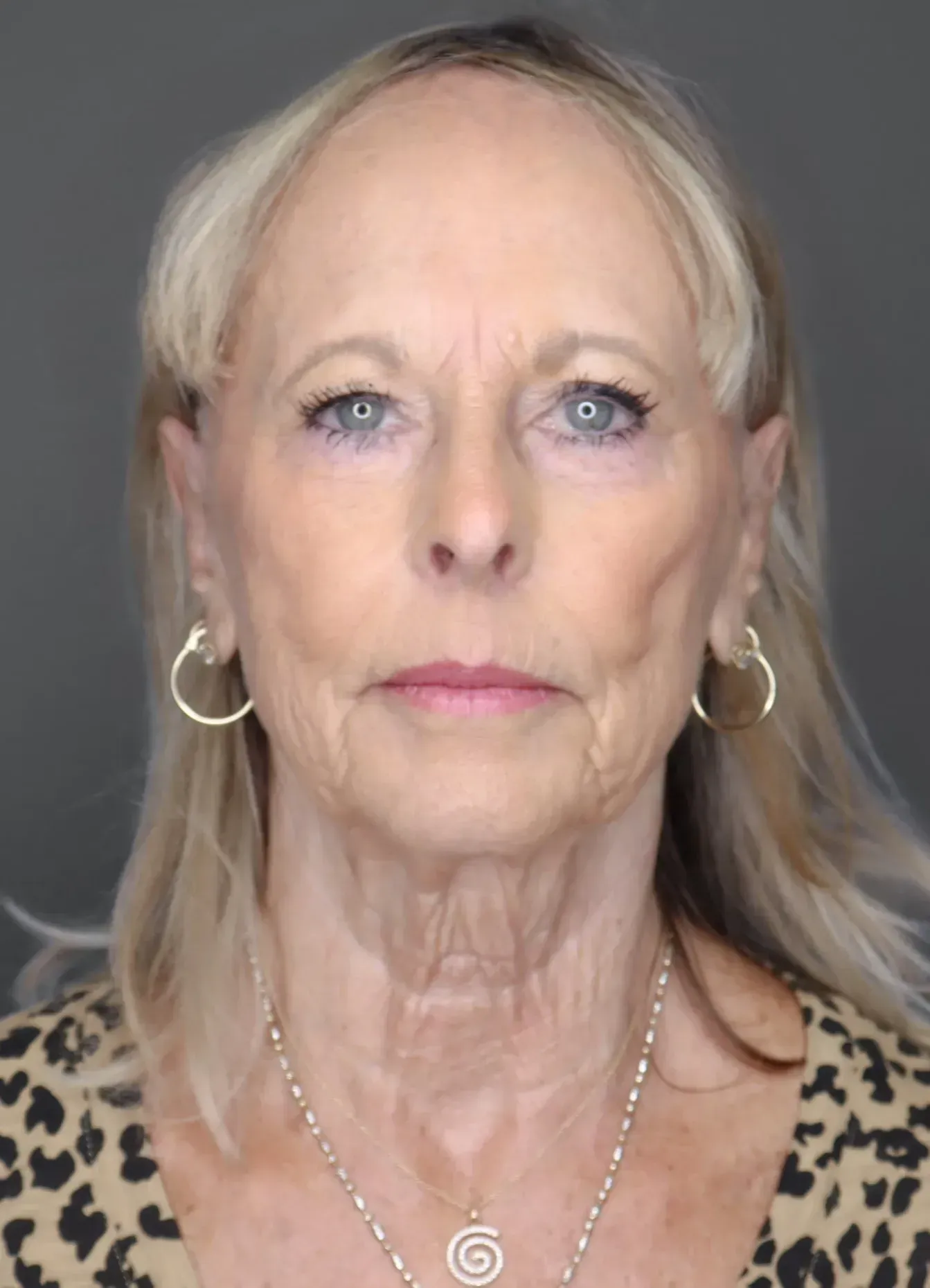 Facelift #8 before
