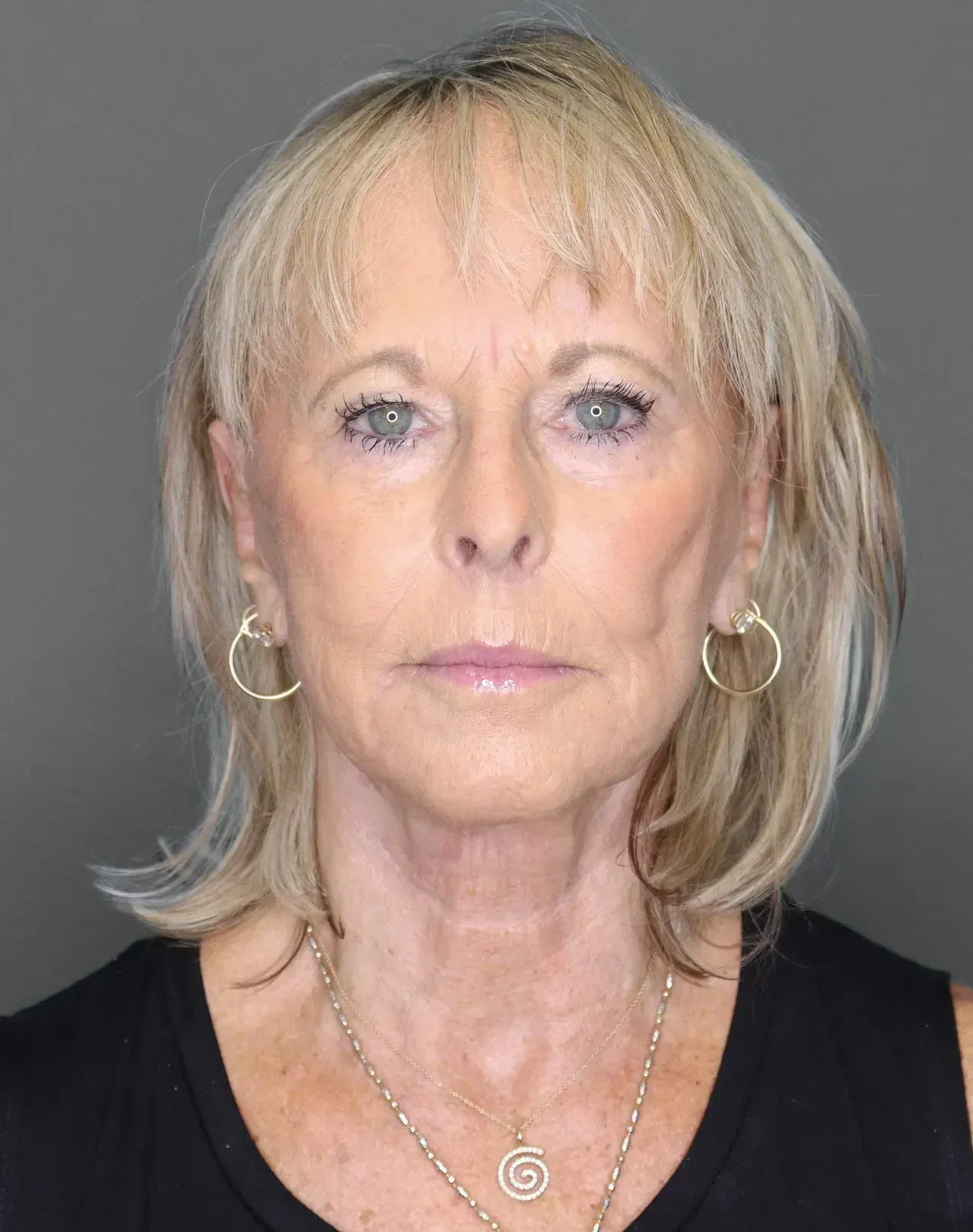 Facelift #8 after