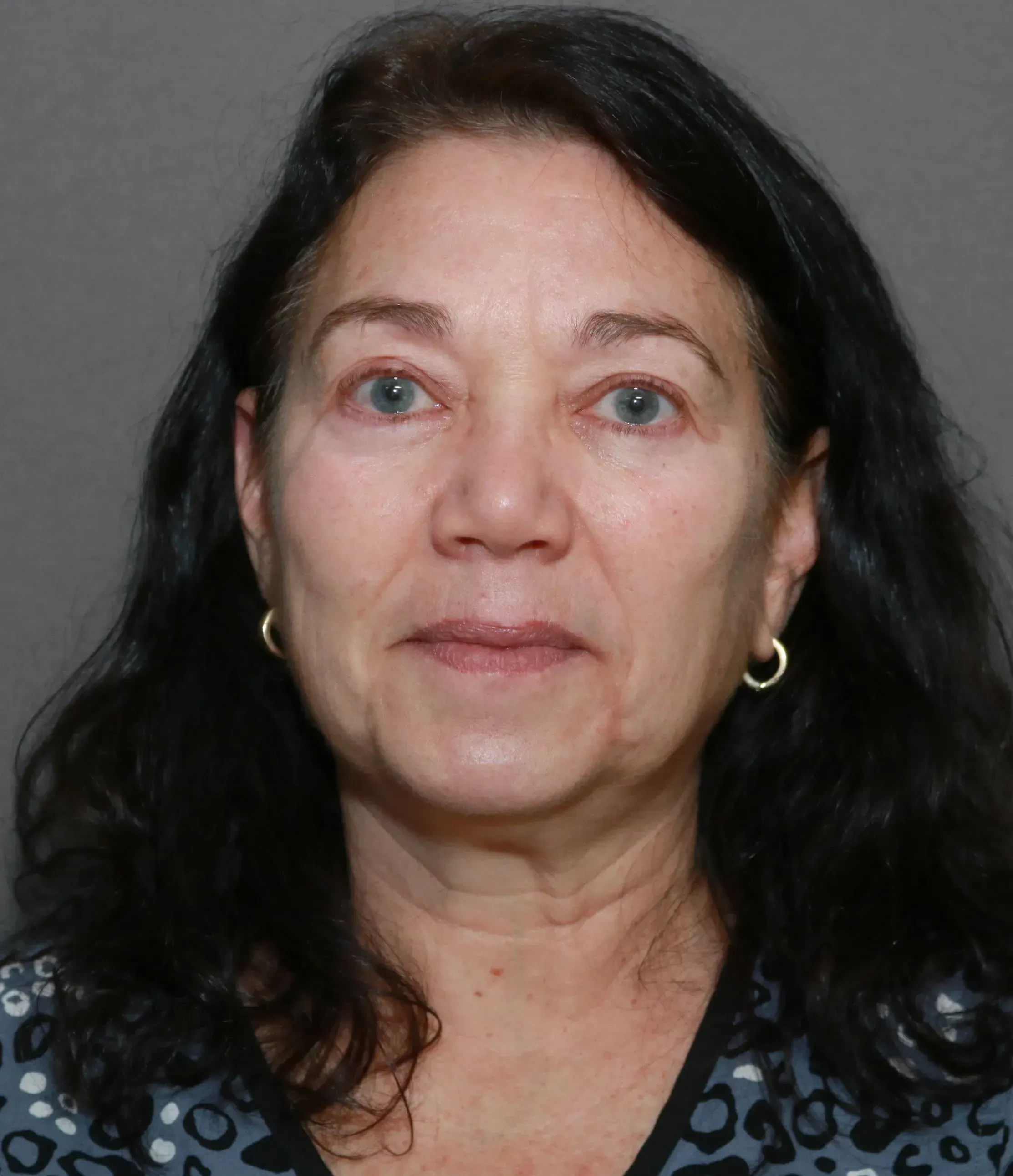 Facelift #7 before