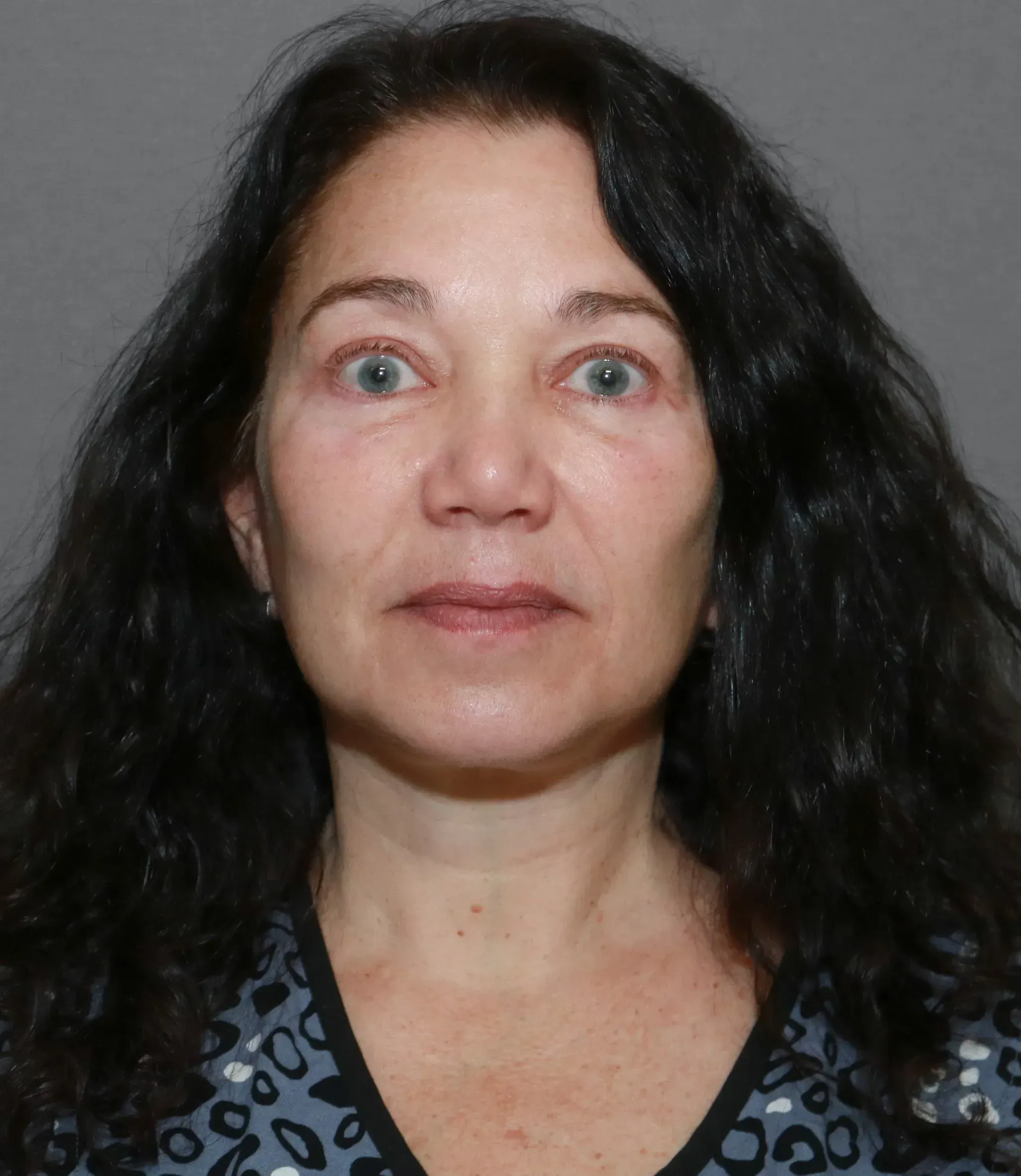 Facelift #7 after