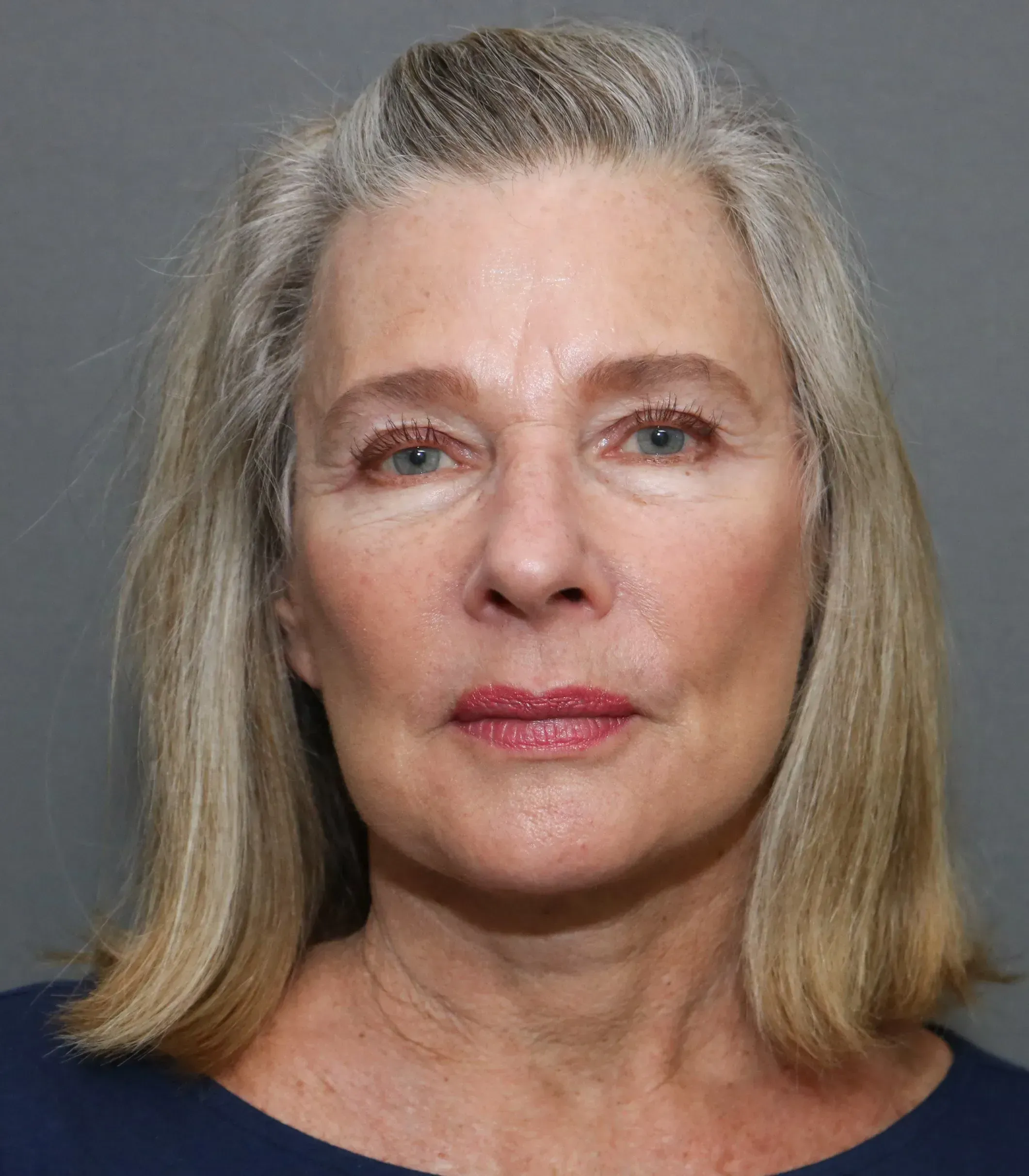 Facelift #6 after