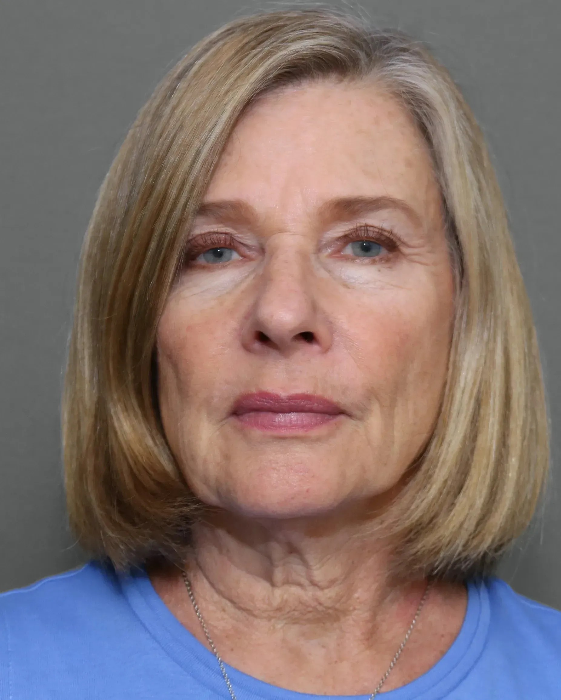 Facelift #6 before