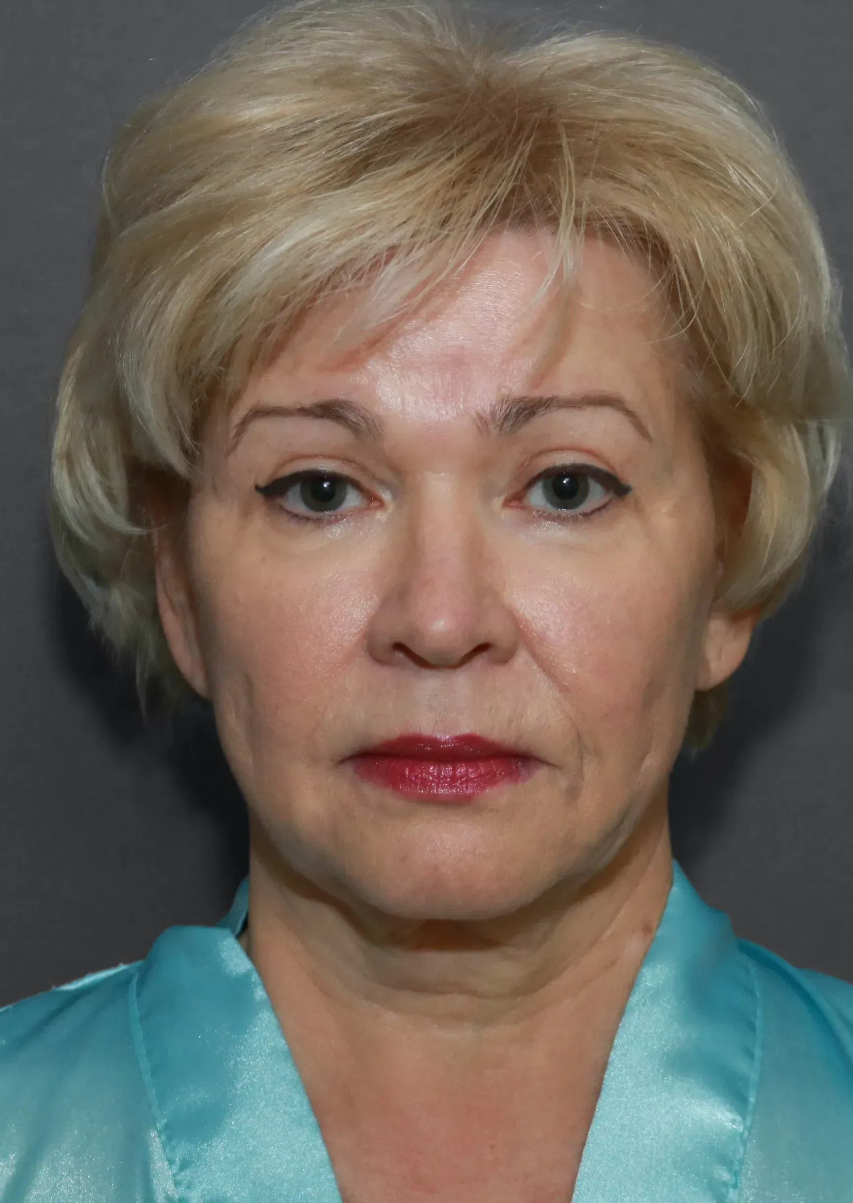 Facelift #5 before