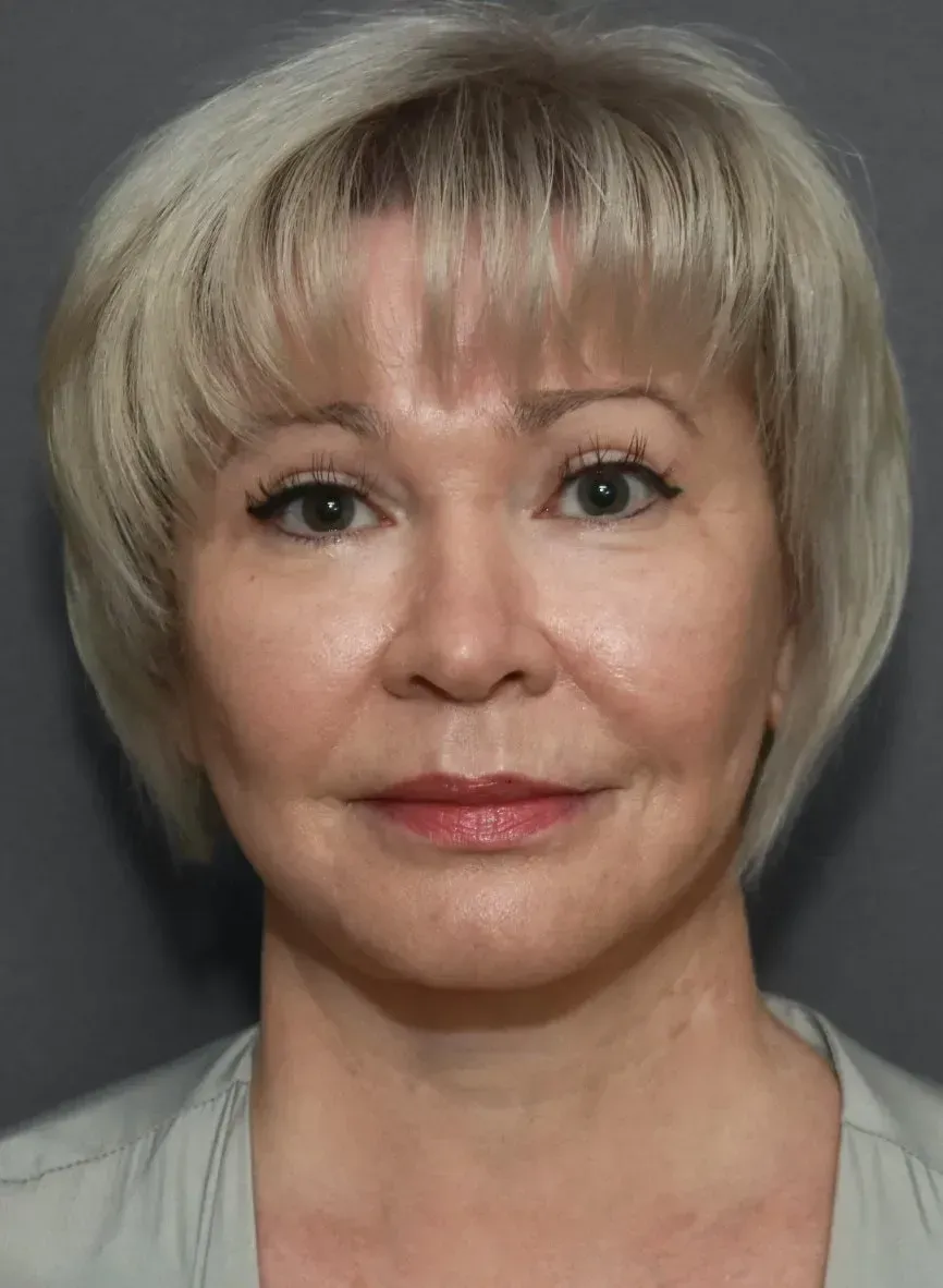 Facelift #5 after