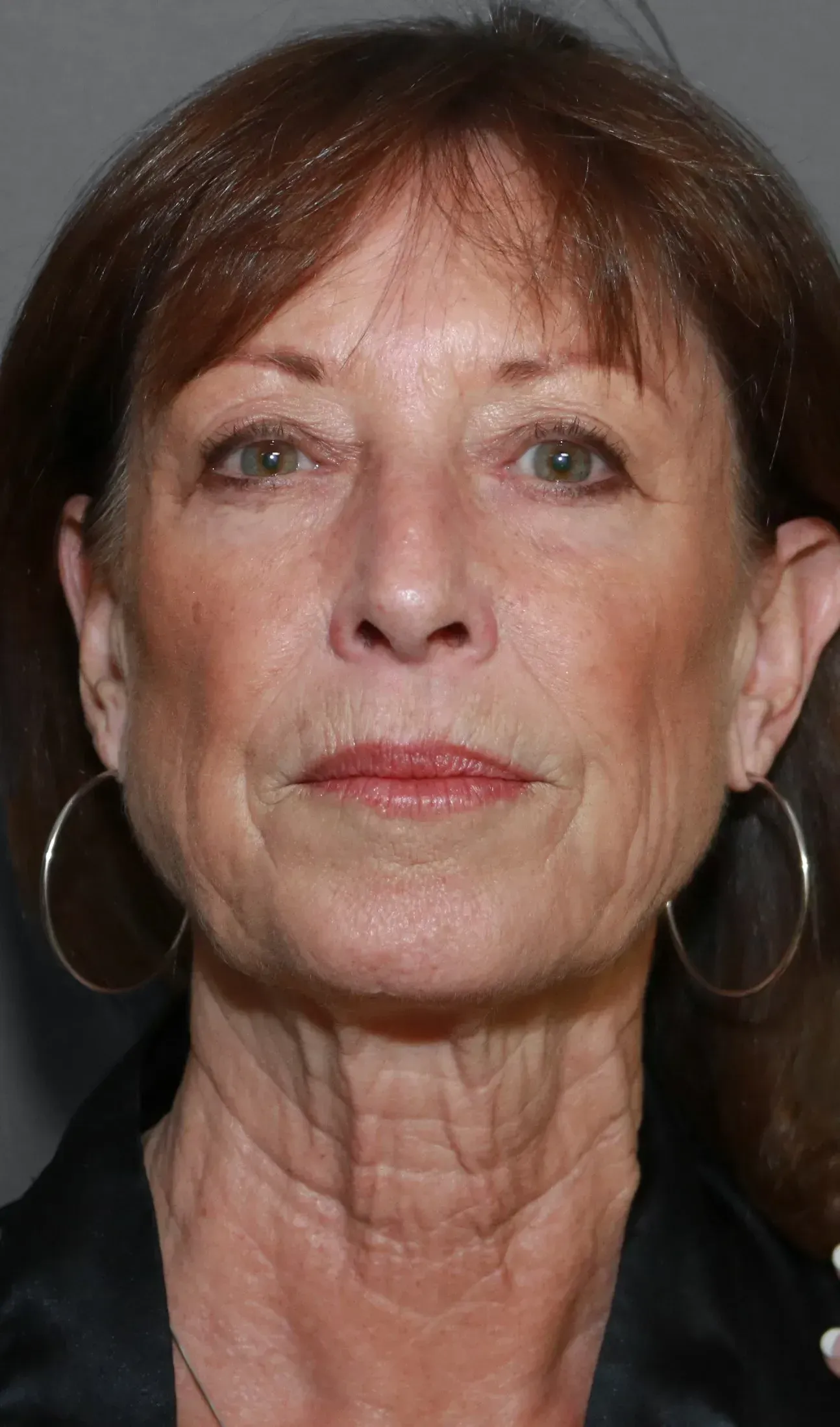 Facelift #3 before