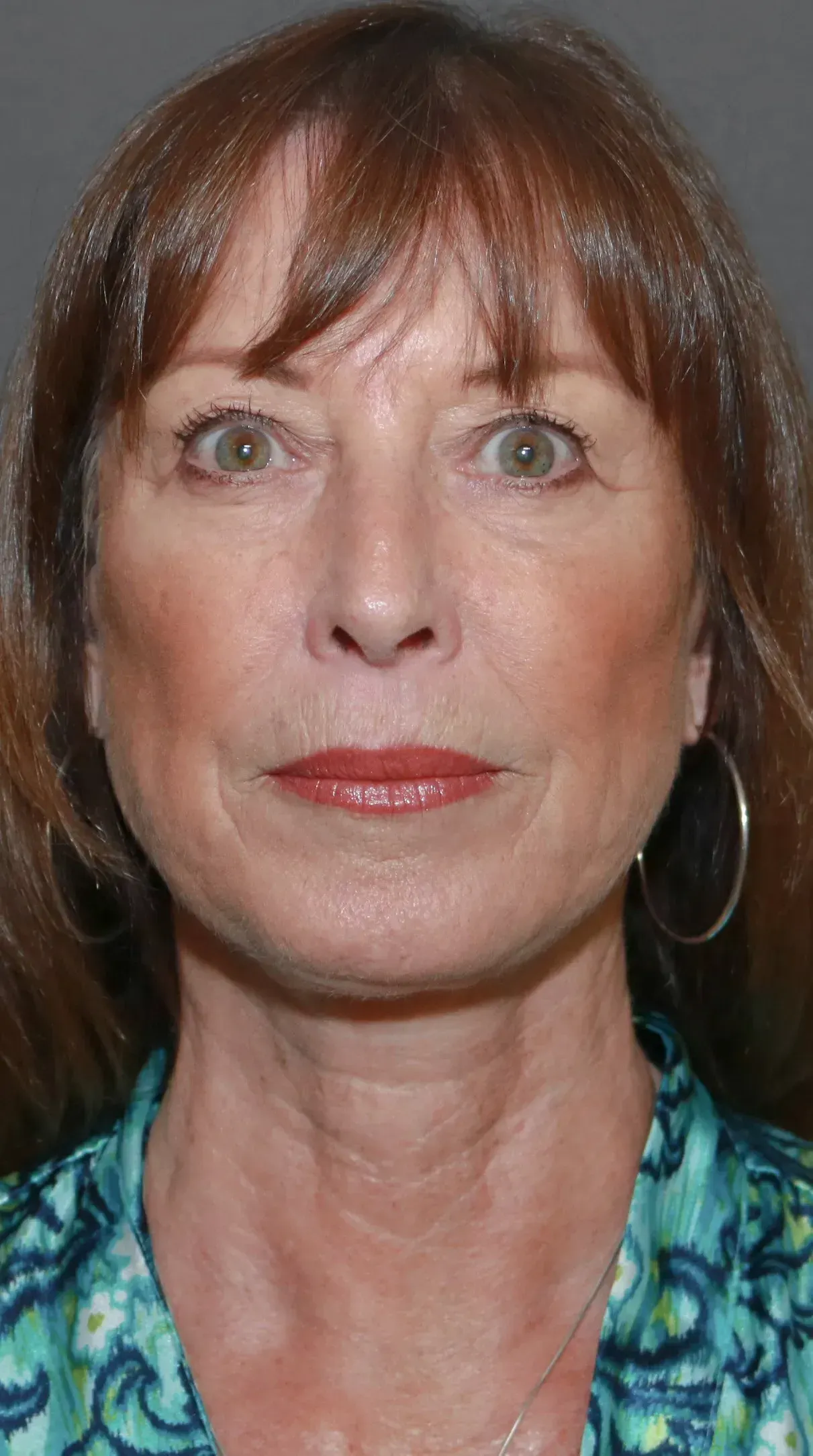 Facelift #3 after