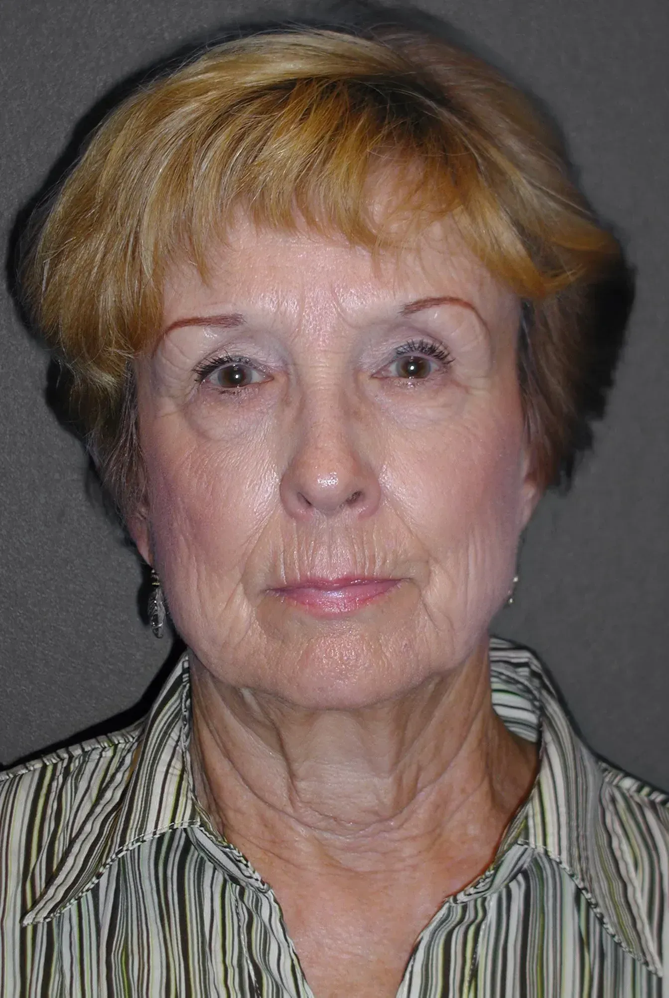 Facelift #2 before