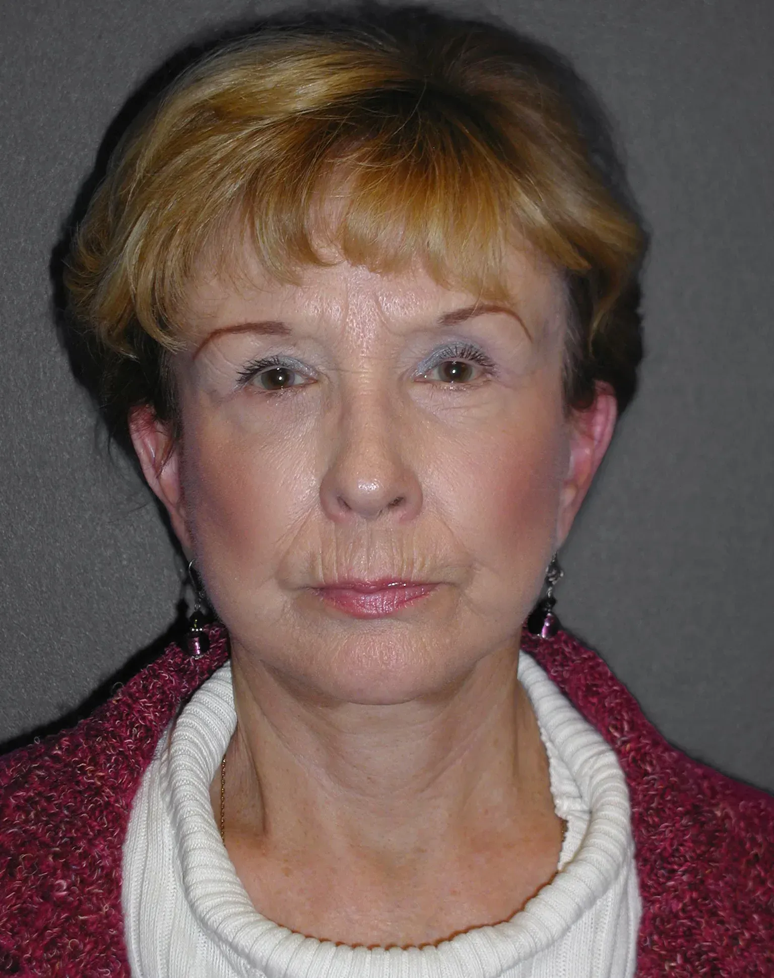 Facelift #2 after
