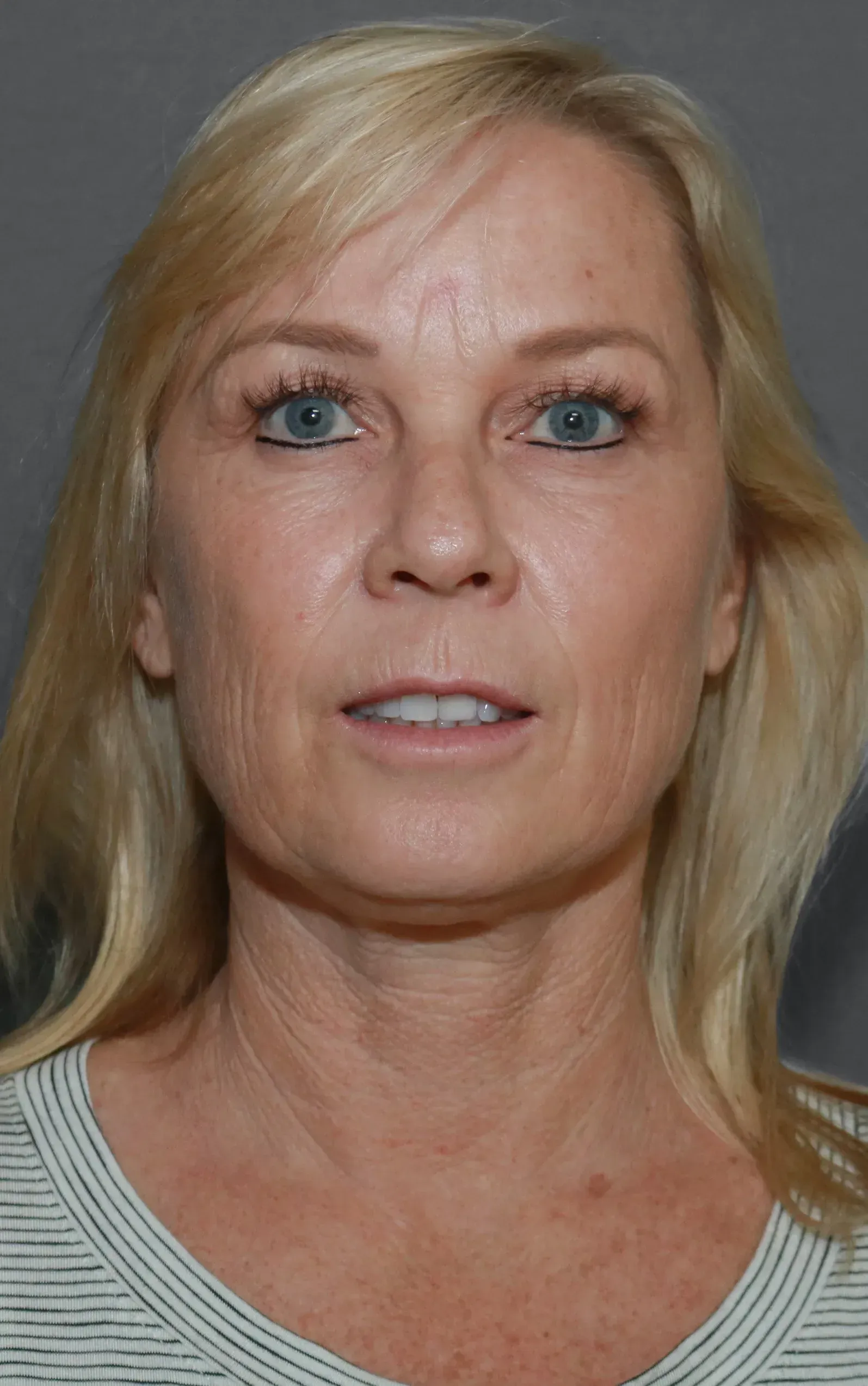 Facelift #1 before