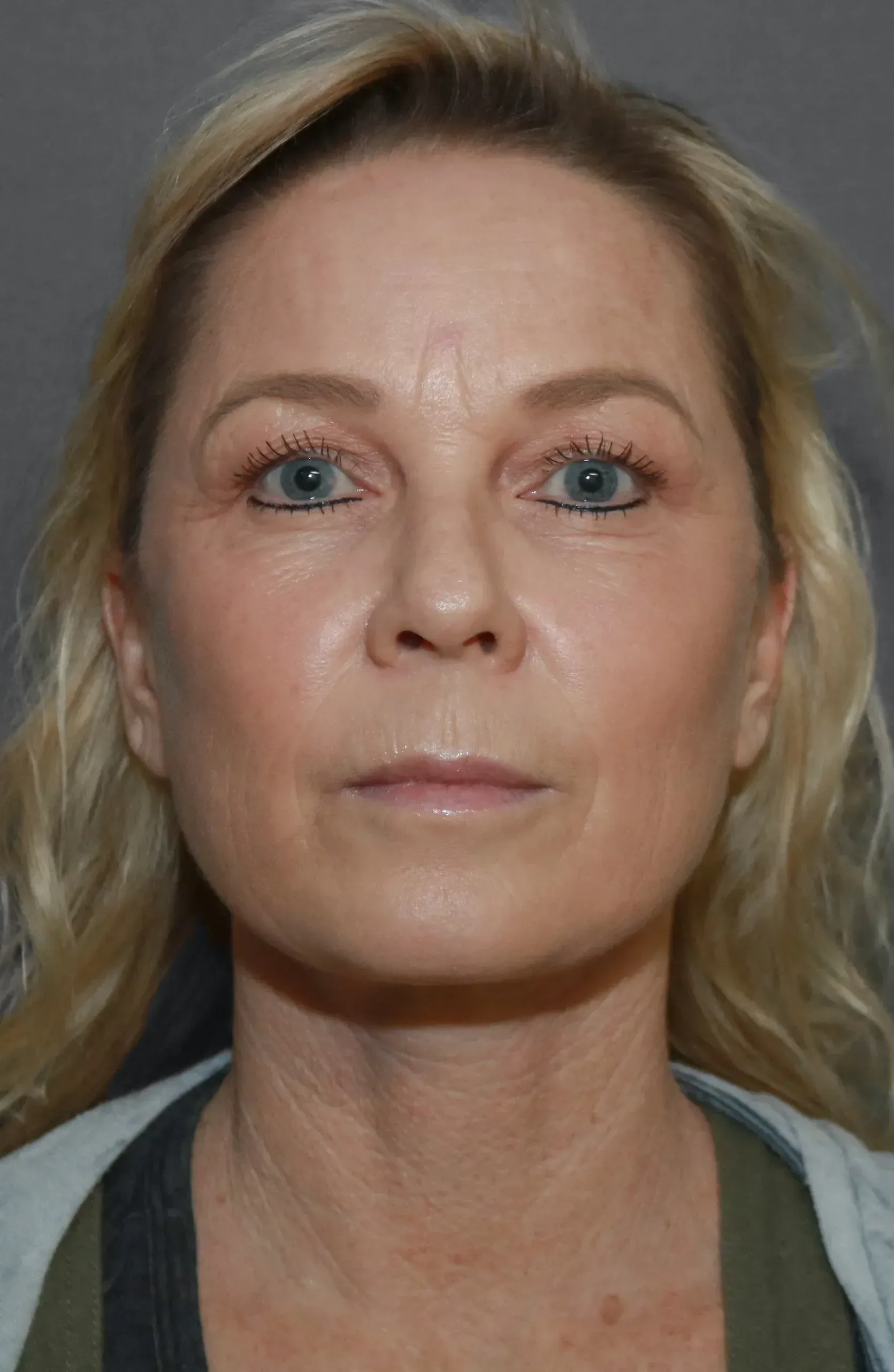 Facelift #1 after