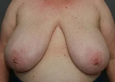 Breast Reduction #1 before