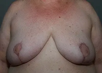 Breast Reduction #1 after