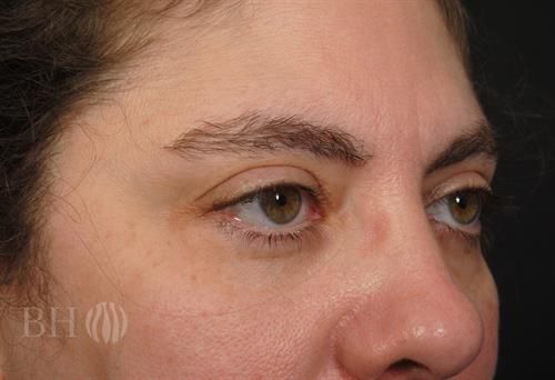 Eyelid Surgery — Patient 02 after