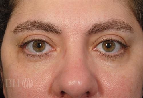 Eyelid Surgery — Patient 02 after