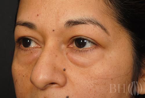 Eyelid Surgery — Patient 07 before