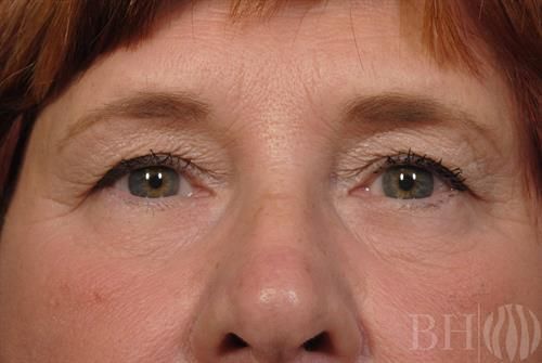 Eyelid Surgery — Patient 17 before
