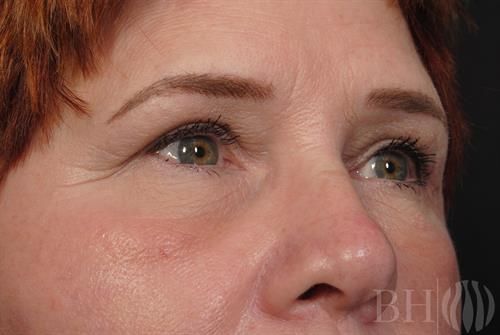 Eyelid Surgery — Patient 17 after