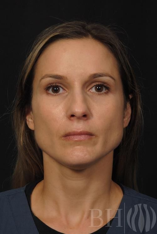 Injectables — Patient 05 before