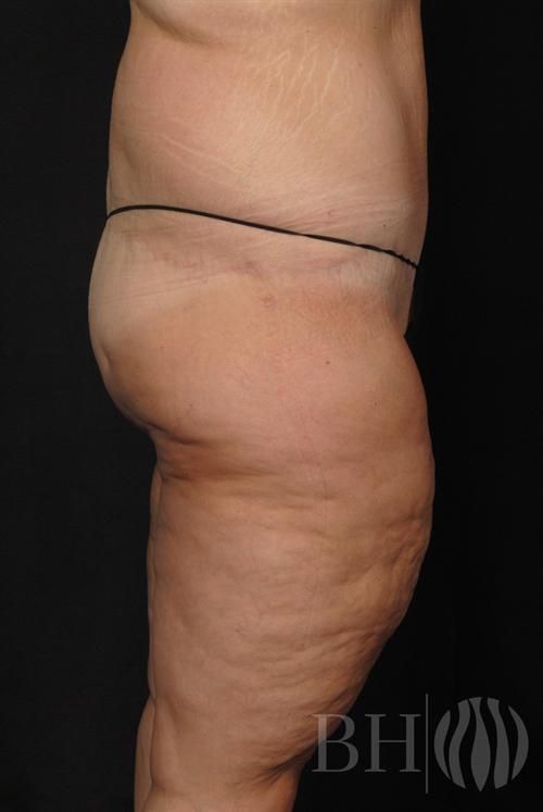 Body Lift — Patient 02 after