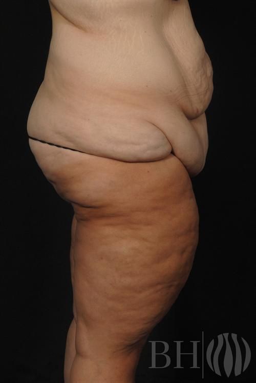 Body Lift — Patient 02 before