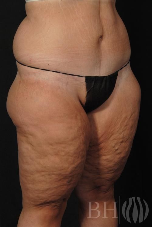 Body Lift — Patient 02 after