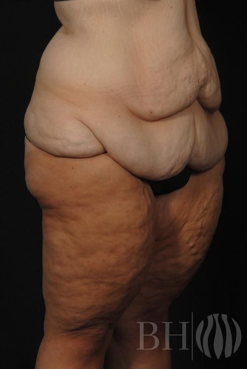 Body Lift — Patient 02 before