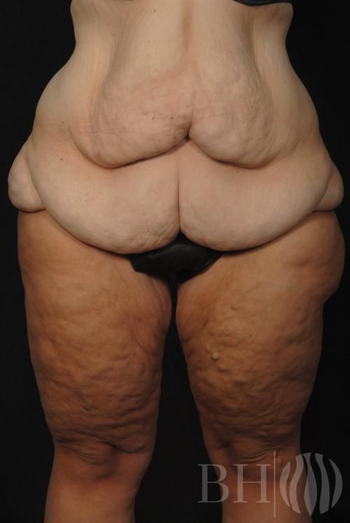 Rear-view clinical before photo of a patient showing significant excess skin and adipose tissue around the buttocks and thighs, with visible cellulite and skin laxity, watermarked with the 'BH' logo in the lower right corner.