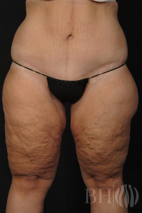 Front view of a person's torso and thighs showing skin texture and body contour, with a 'BH' watermark logo visible in the lower right corner.