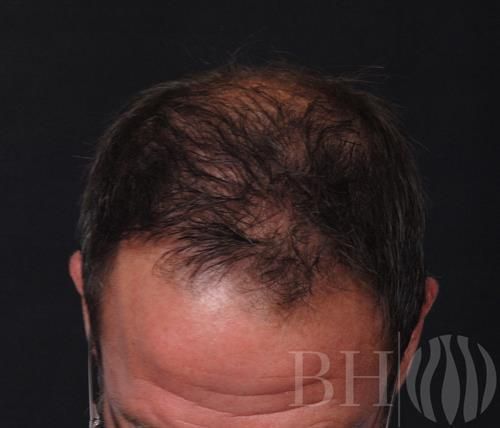 Close-up top view of a man's head showing significant hair thinning at the crown and vertex, with a 'BH' logo watermark in the lower right corner.