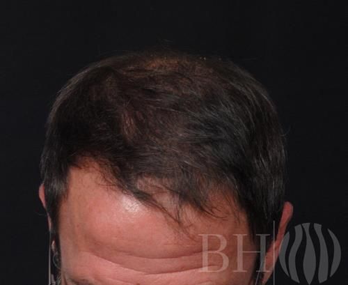 Close-up top view of a man's head showing dark hair with visible hair follicles, likely a post-procedure result photo for NeoGraft hair restoration, with the 'BH' logo watermark in the lower right corner.