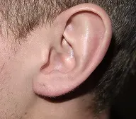Earlobe Repair after