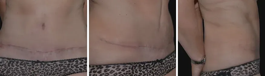 Tummy Tuck after