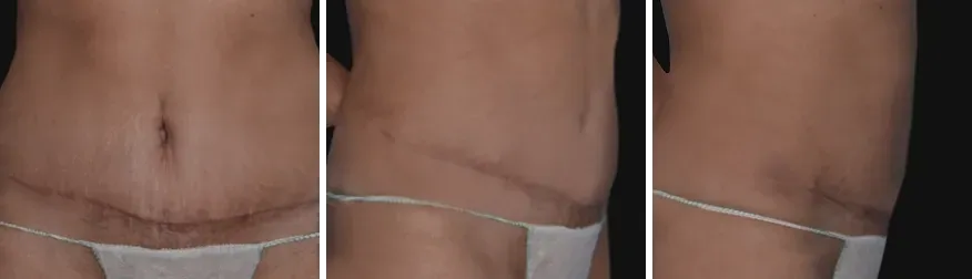 Tummy Tuck after